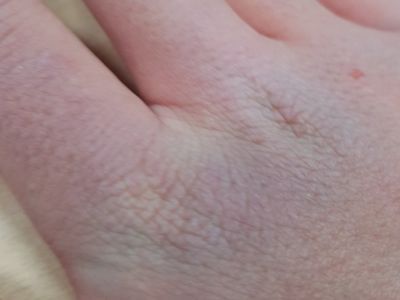 Обмороженная рука школьника. Фото: twitter.com Обмороженная рука школьника. Фото: twitter.com