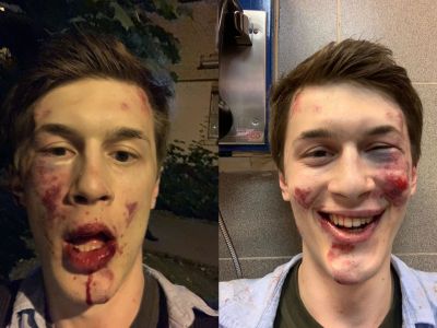 Егор Жуков после нападения. Фото: Команда Жукова / Telegram Егор Жуков после нападения. Фото: Команда Жукова / Telegram